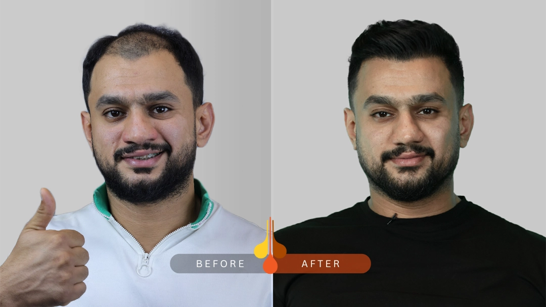 hair-transplant-1