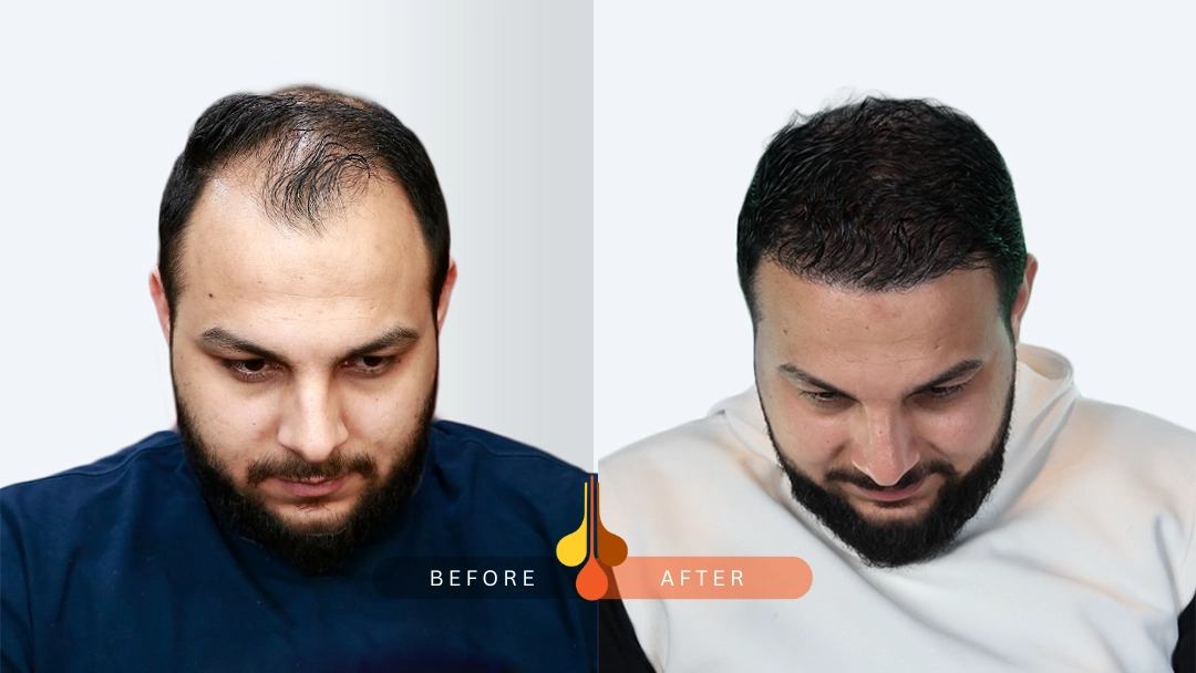 hair-transplant-3